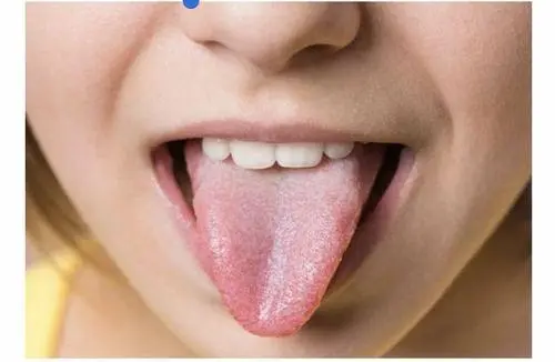 舌头上面有白苔是什么原因引起的